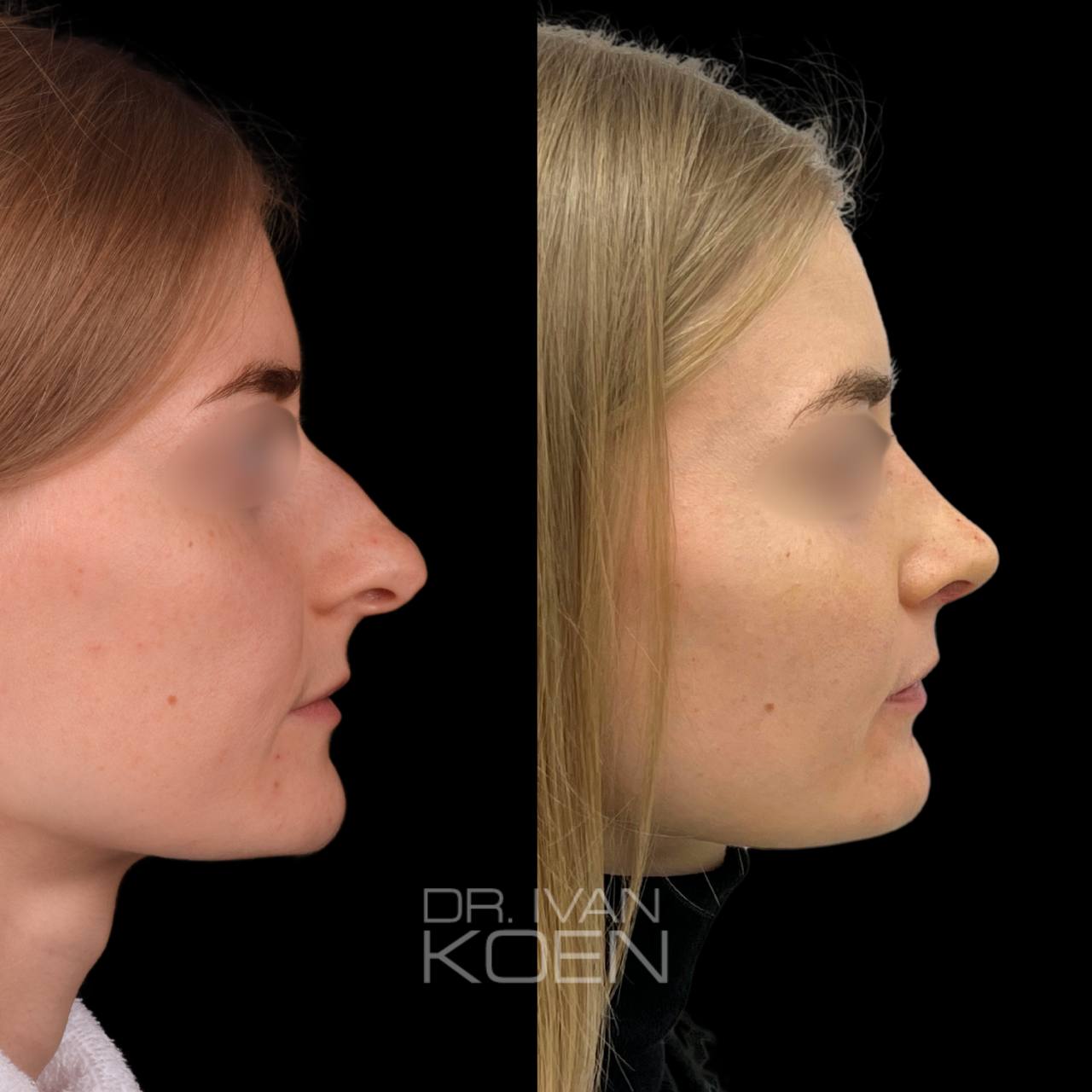 Практические шаги подготовки к операции по ринопластике носа
